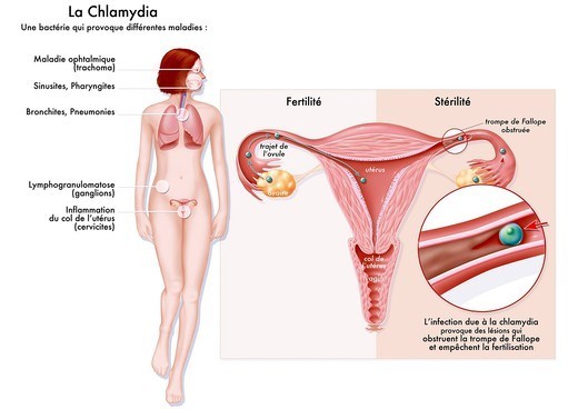 chlamydia-infection-vagin-femme-sante-intime chlamydia-infection-vagin-femme-sante-intime