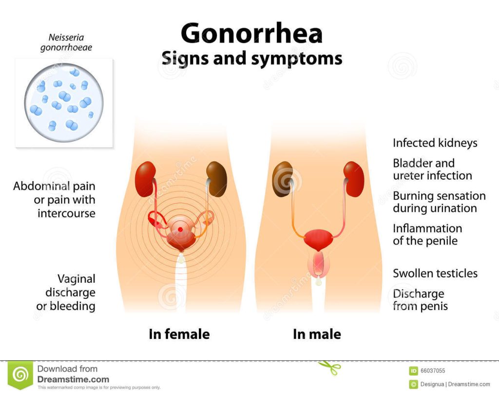 gonorrhée-ou-infection-gonnococcal-blenorragie-sante-intime