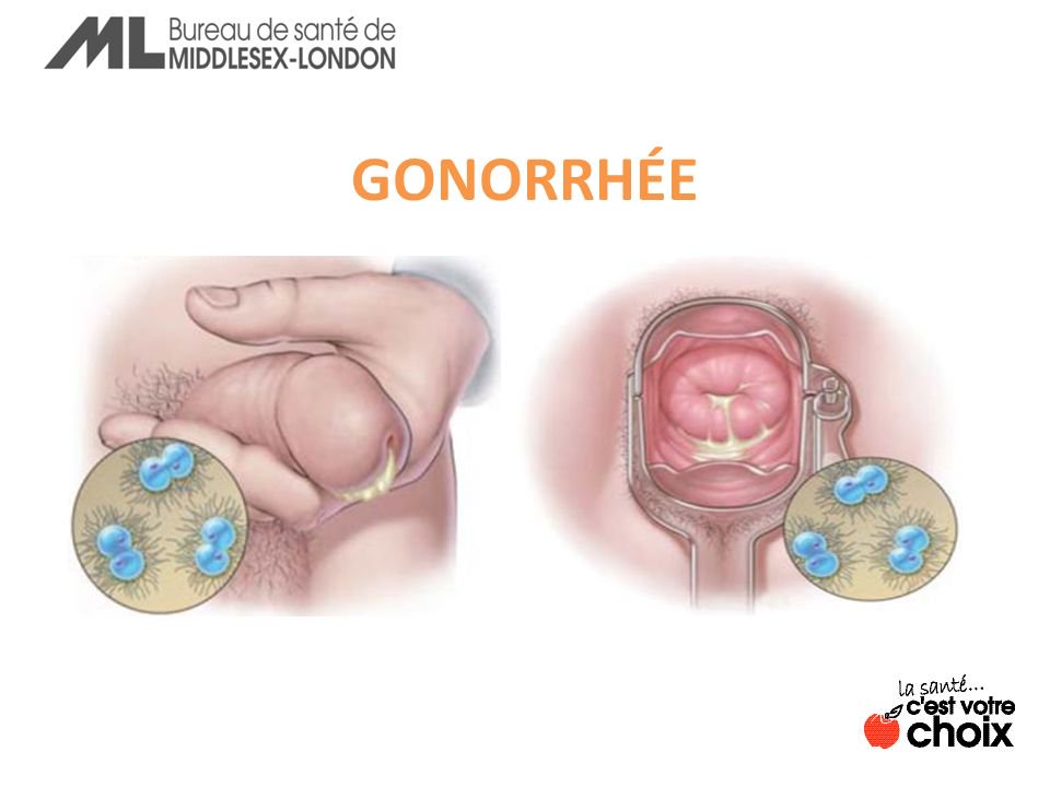 Symptomes-et-traitement-de-la-blennorragie-gonorrhee-sante-intime-2