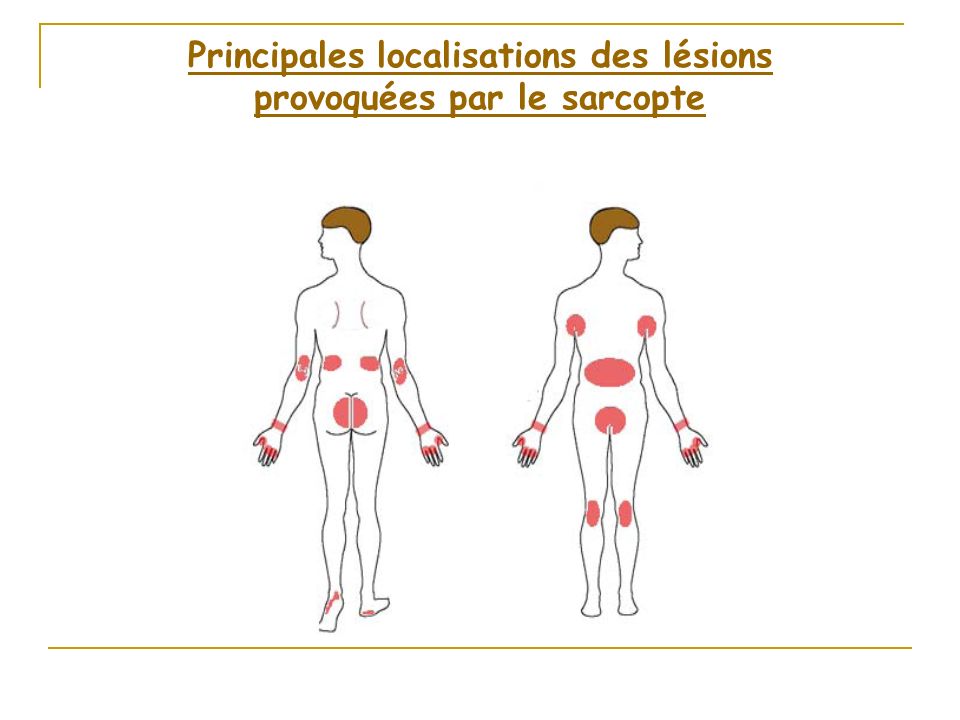 Principales+localisations+des+lésions+provoquées+par+le+sarcopte-sante-intime